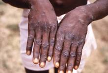 جدري-القرود