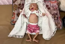 طفلة-وسوء-تغذية-1752844101