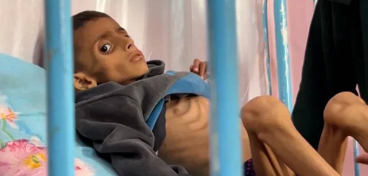 الحصار يفتك بأطفال غزة: استشهاد 66 طفلاً نتيجة سوء التغذية 