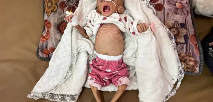 شهيد الجوع الثاني خلال 24 ساعة في قطاع غزة 