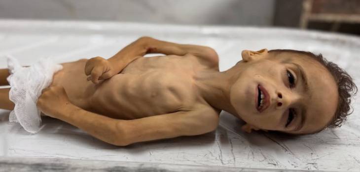 الصحة في غزة: 500 رضيع يصارعون الجوع وسوء التغذية