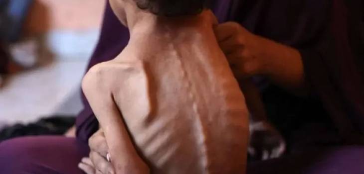185 وفاة في غزة بسبب التجويع خلال أغسطس