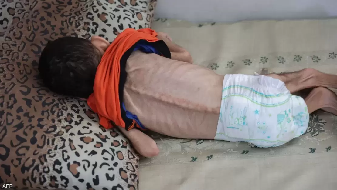 نفاد غذاء الأطفال في غزة وتحذيرات أممية من المجاعة 