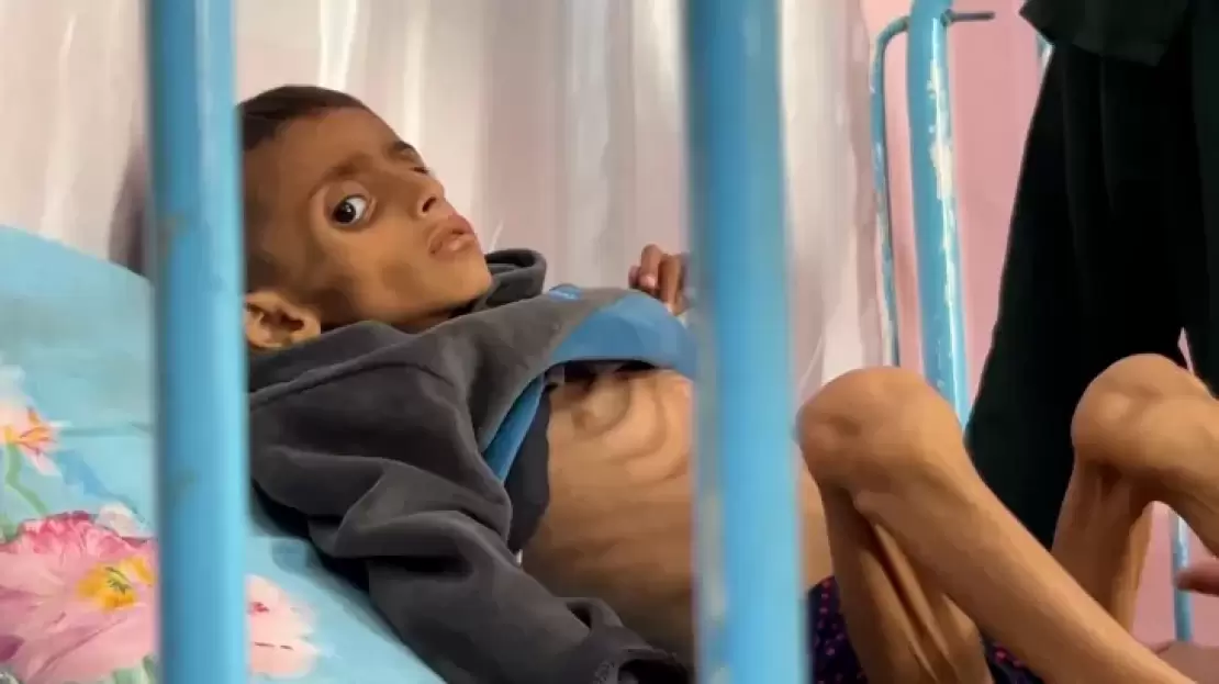 الحصار يفتك بأطفال غزة: استشهاد 66 طفلاً نتيجة سوء التغذية 