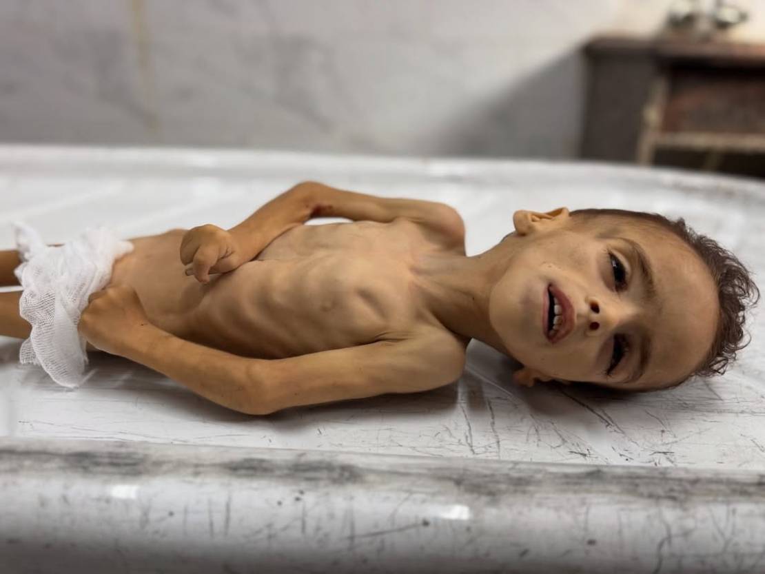 الصحة في غزة: 500 رضيع يصارعون الجوع وسوء التغذية