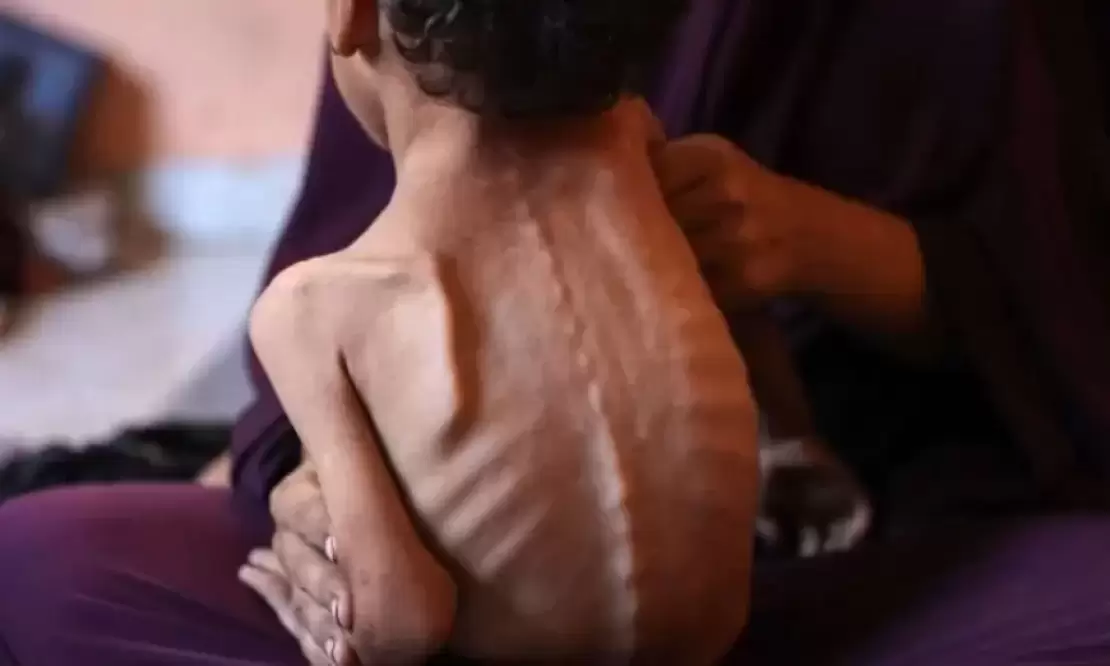 185 وفاة في غزة بسبب التجويع خلال أغسطس